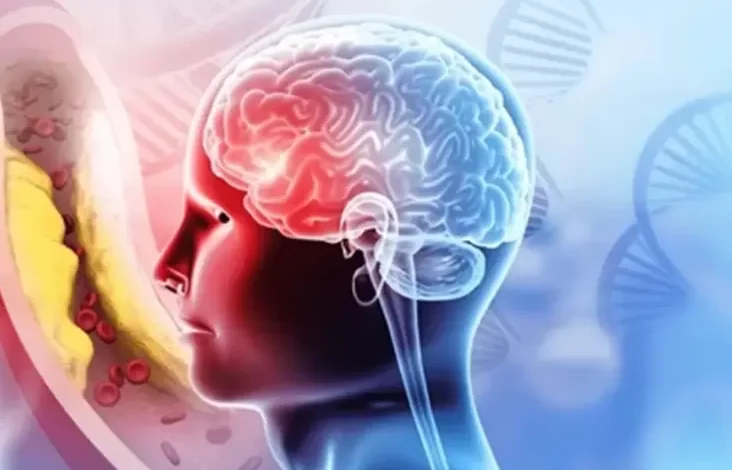 Kegunaan Penanganan Stroke Cepat, Jangan Lewati Golden Periode agar Pulih Lebih Baik