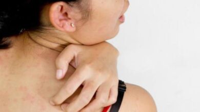 Penderita penyakit kencing manis kemudian obesitas rentan terkena jamur ke epidermis